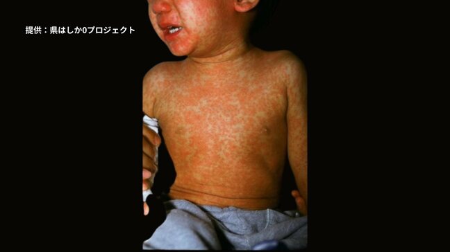 石垣島に麻しん（はしか）患者の来島が判明　島の訪問者は6月9日まで高熱・発疹などの症状に注意|TBS NEWS DIG