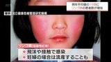 リンゴ病(伝染性紅斑) 宮崎県内の感染者数が例年の10倍に 県が対策の徹底を呼びかけ | MRTニュース | MRT宮崎放送