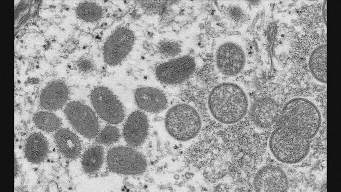 エムポックス重症型の感染者　アメリカで初めて確認|TBS NEWS DIG