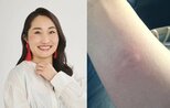 【 キンタロー。 】 「誰か虫博士助けて」　ぷっくり腫れた腕の写真を投稿　フォロワーに助け求める|TBS NEWS DIG