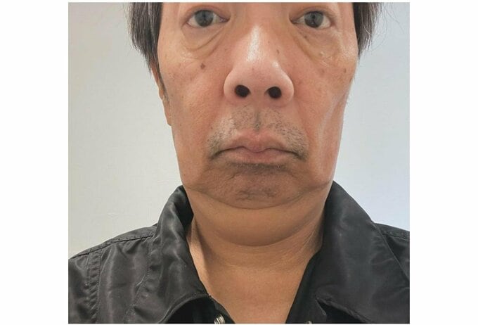 ステージ４【下咽頭がん】　見栄晴さん　「首が腫れ出し」「放射線治療の副作用」|TBS NEWS DIG