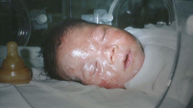 「『大丈夫だよ、何も心配しなくてもいいよ』という安易な言葉はかけない」魚鱗癬の子供を育てた母が新米ママとパパに語ること　|　福岡のニュース｜RKB NEWS｜RKB毎日放送