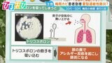 梅雨の長引く咳…白いカビが原因?「夏型過敏性肺炎」に注意【ひるおび】|TBS NEWS DIG