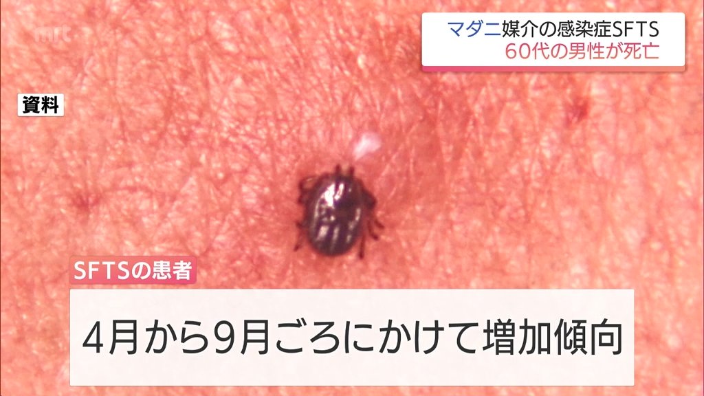 死性病　位置原光z クサダ 黒咲練導 随時　panpanya 平方イコルスン マダニが媒介する感染症「SFTS」 宮崎県内で男女2人が感染 60代男性が