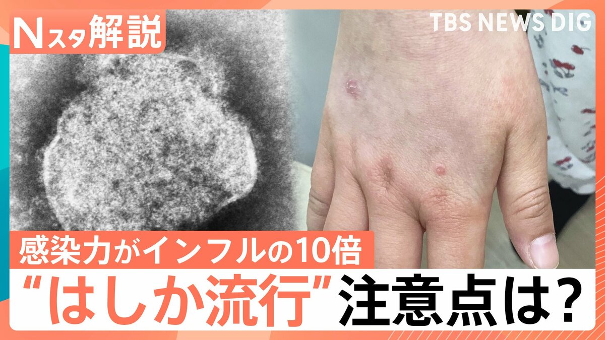はしか「発症の1日前から感染力」「風邪のような症状のあとに発疹」26~53歳は特に注意!ワクチン接種歴の確認を【Nスタ解説】 | TBS ...