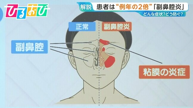 「副鼻腔炎」黄砂や花粉も原因に…受診の目安や予防法は【ひるおび】|TBS NEWS DIG