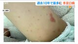 「2人同時になって…」ウイルス禍で流行なく“免疫がない”?『手足口病』この時期としては過去10年で最多 大人は重症化も | 新潟のニュース・天気|BSN NEWS|BSN新潟放送