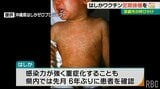 6年ぶりの「はしか」患者 沖縄で確認をうけて那覇市がワクチン定期接種を呼びかけ|TBS NEWS DIG