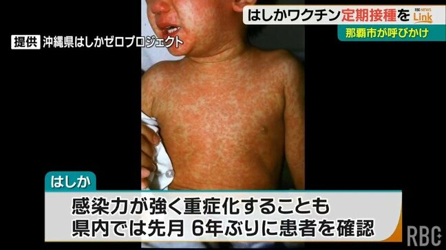 6年ぶりの「はしか」患者　沖縄で確認をうけて那覇市がワクチン定期接種を呼びかけ|TBS NEWS DIG