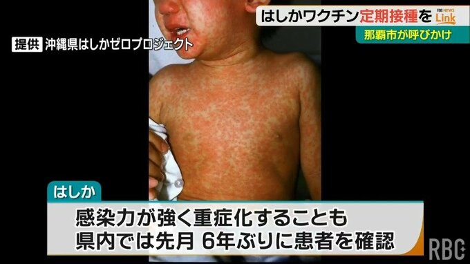 6年ぶりの「はしか」患者　沖縄で確認をうけて那覇市がワクチン定期接種を呼びかけ　|　沖縄のニュース｜RBC 琉球放送