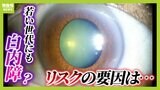 【白内障】放置すると失明のおそれも...『まぶしい』『目がかすむ』の症状が出たら眼科受診のサイン？医師は「若年層でも増えている感覚がある」と指摘|TBS NEWS DIG
