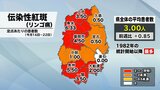 リンゴ病1定点患者数3.00人で過去最多 前の週を0.85上回る 「百日せき」はやや減少 岩手|TBS NEWS DIG
