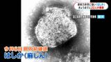 “はしか”広がる 全国で去年同時期の4倍以上 専門家「感染力がずば抜けて高い」症状と予防を詳しく|TBS NEWS DIG