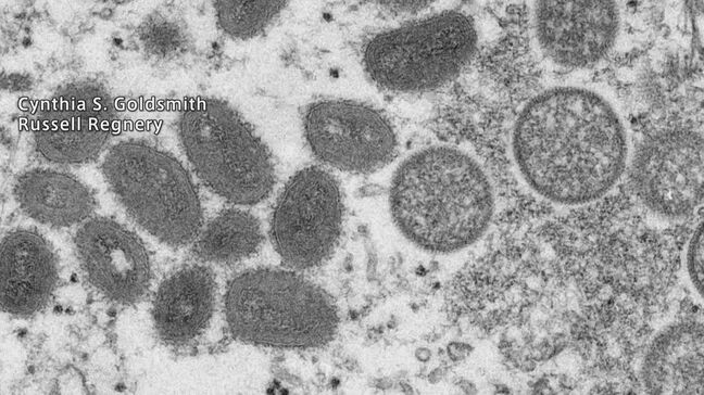 エムポックス重症型が日本国内で初確認　アフリカに渡航歴ある20代女性　厚生労働省|TBS NEWS DIG