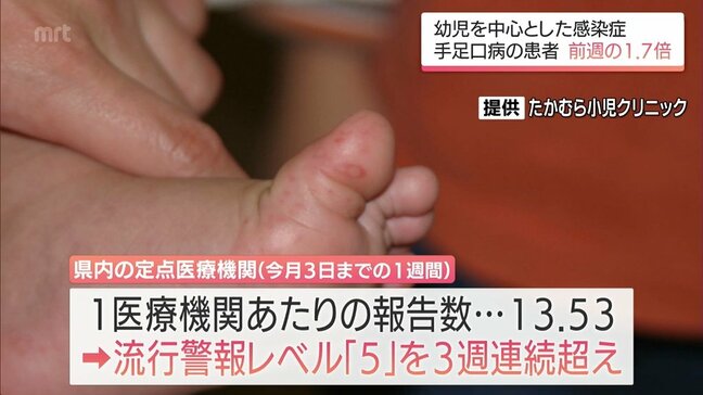 幼児を中心とした感染症「手足口病」 宮崎県内の患者数は前週比1.69倍 3週連続で流行警報レベル超|TBS NEWS DIG