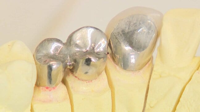 「経営としては非常に厳しい」銀の価格高騰で歯科医院から悲鳴 店頭小売価格は半年で3倍 銀歯など医院側の負担増に|TBS NEWS DIG