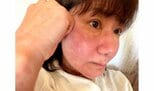 【 がん闘病 】古村比呂さん　突如発症した〝薬アレルギー〟　現況明かす　「赤い肌は明日落ち着きますように」|TBS NEWS DIG