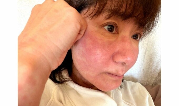 【 がん闘病 】古村比呂さん　突如発症した〝薬アレルギー〟　現況明かす　「赤い肌は明日落ち着きますように」|TBS NEWS DIG