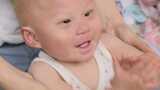 「天使の子」ちーちゃんの病気は100万人に1人の難病「KID症候群」 母は”最初は受け止められるか怖かった” | 福岡のニュース|RKB NEWS|RKB毎日放送