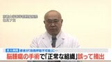 【速報】脳腫瘍手術で「正常な組織」を誤って摘出…自発呼吸不能の重篤状態に 「腫瘍でない」結果出ても“勘違い”で摘出継続 通常の生活送っていた患者が手足も動かず 京大病院|TBS NEWS DIG