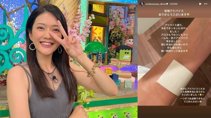 田中道子さん「ドライヤー爆発して腕持ってかれた」腕の皮膚が黒ずむ火傷「冷水でキンキンに冷やしました」|TBS NEWS DIG