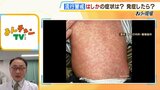 【はしか】感染力は『コロナの3倍、インフルの10倍』年齢とワクチン接種回数の目安を知ろう！症状は『発熱・発疹・コプリック斑』【MBSニュース解説】|TBS NEWS DIG