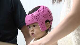 気になる｢赤ちゃんの頭の形｣→｢頭の形外来｣を開設する病院増加→病気でないゆがみは高額｢ヘルメット治療｣→必要か冷静に判断を|TBS NEWS DIG