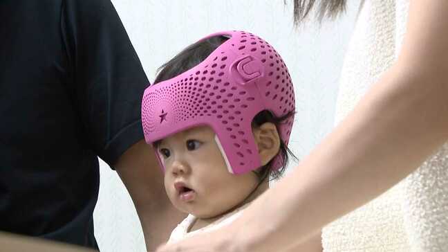 気になる｢赤ちゃんの頭の形｣→病気でないゆがみは高額｢ヘルメット治療｣→必要か冷静に判断を　｢頭の形外来｣を開設する病院増加|TBS NEWS DIG