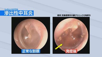 徐々に周りの骨を溶かして…」放っておくと危険な “中耳炎” 子どもから