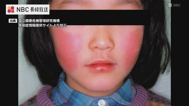 子どもに多く見られるリンゴ病（伝染性紅斑）1999年以降で最多を更新【長崎】|TBS NEWS DIG
