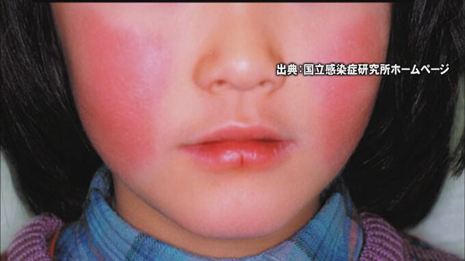 「りんご病」流行、警戒　特に妊婦は注意必要「流産の原因になったりもする」医師指摘　　|　BSSニュース | BSS山陰放送