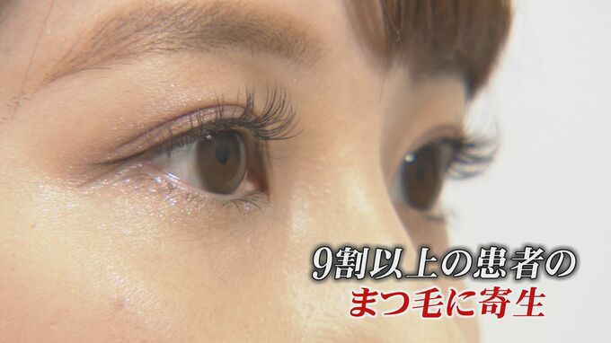 まつ毛1本に平均3匹…眼科を受診した患者の9割以上に “まつ毛ダニ”が寄生　古い化粧品は要注意！目のトラブルの原因かも|TBS NEWS DIG