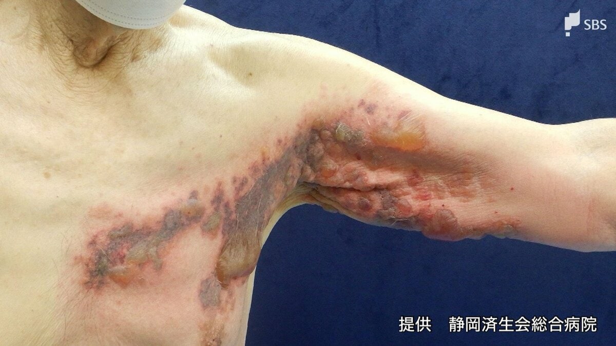 「帯状疱疹」が20~40代に増えているワケは“水痘ワクチン”接種⁉ 回数も「一生に一度」ではない⁉ | TBS NEWS DIG (3ページ)