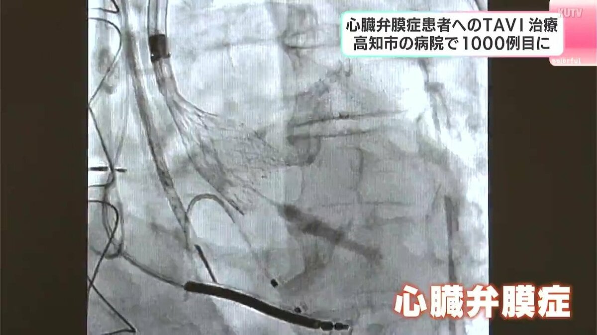 「特に高齢者、高知県にぴったり」カテーテルを使った手術　心臓弁膜症の患者へのTAVI　高知市の病院で1000例目に　