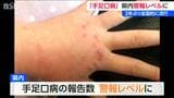 手足口病 2年ぶり流行し警報レベルに 国の警報基準5を超える 新潟県 | 新潟のニュース・天気|BSN NEWS|BSN新潟放送