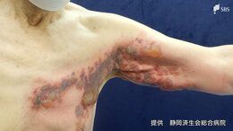 「帯状疱疹」が20～40代に増えているワケは“水痘ワクチン”接種⁉ 回数も「一生に一度」ではない⁉|TBS NEWS DIG