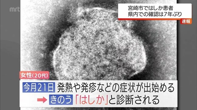 宮崎市で「はしか」感染 20代女性が県外滞在後に発症　MEGAドンキなど利用|TBS NEWS DIG
