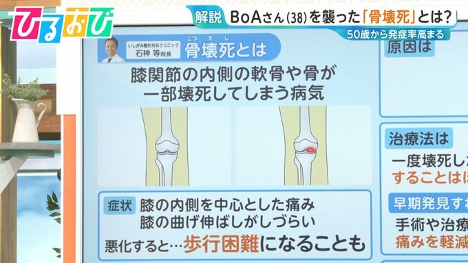原因は不明『骨壊死』とはどんな病気？治療法や気を付けるべきことを専門医に聞く【ひるおび】|TBS NEWS DIG