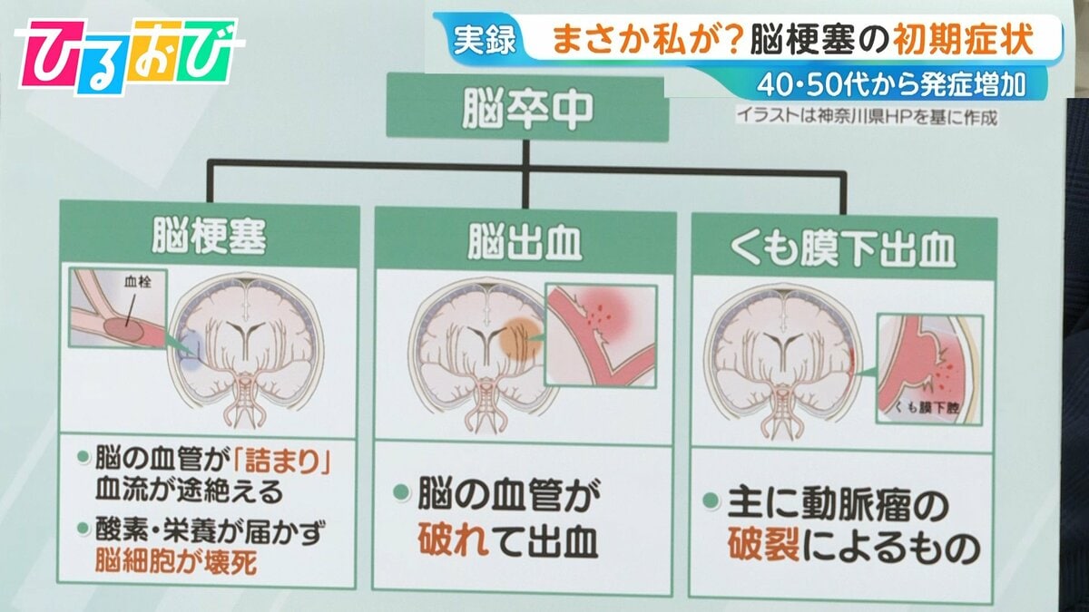 40代から増加「脳梗塞」の初期症状は？「倒れてからじゃ遅い」早期発見のカギ「BE FA…