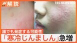 強いかゆみ…「寒冷じんましん」に注意!冷たい飲み物の一気飲みでも発症? 医師「誰でも発症しうる」【Nスタ解説】|TBS NEWS DIG