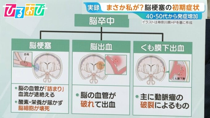 40代から増加「脳梗塞」の初期症状は？「倒れてからじゃ遅い」早期発見のカギ「BE FAST」とは【ひるおび】|TBS NEWS DIG