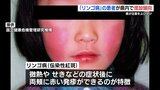 前の年の「15倍以上」熊本県内でもリンゴ病が増加 |TBS NEWS DIG