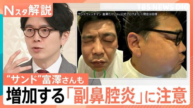 “顔の腫れ”に“視力低下”のおそれも…増加する「副鼻腔炎」 花粉のピークが過ぎた季節に注意したい“鼻トラブル”【Nスタ解説】|TBS NEWS DIG