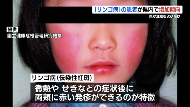 前の年の「15倍以上」熊本県内でもリンゴ病が増加　|TBS NEWS DIG
