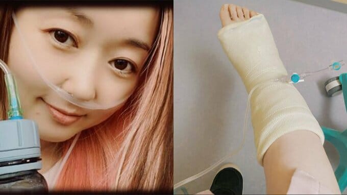 ものまねシンガー・荒牧陽子さん　右足首の手術とステージお休みを公表　「10年以上誤魔化しながら使ってた右足首の靱帯」|TBS NEWS DIG