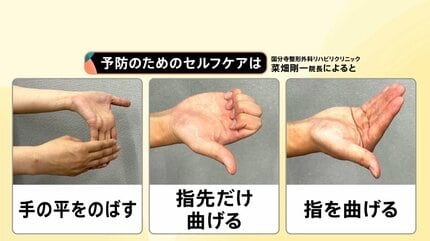 スマホで指にしびれ…それ「手根管症候群」かも “OKサイン”で今すぐ