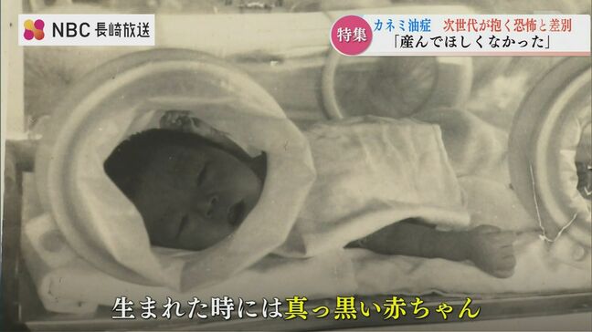 「黒い赤ちゃん」は今　油症二世として生まれた子どもたち　"へその緒”で続く猛毒の連鎖【カネミ油症】|TBS NEWS DIG