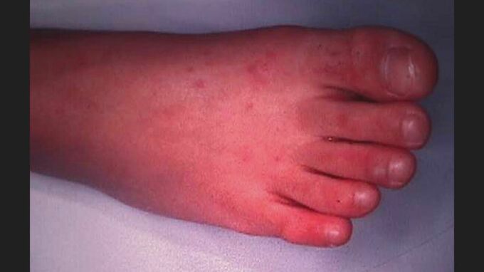 手足口病の感染広がる　西日本中心に23府県で警報基準超　山口県では流行発生警報発令　|　山口のニュース・天気・防災｜tys NEWS｜ｔｙｓテレビ山口