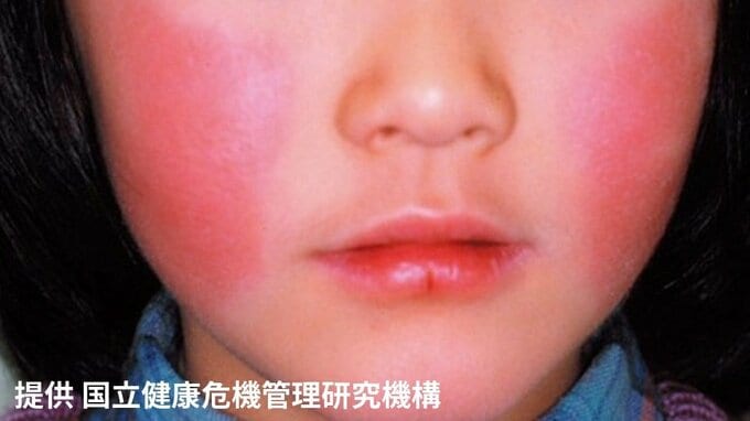 那覇市でリンゴ病警報　妊婦が感染した場合 流産につながる可能性も|TBS NEWS DIG