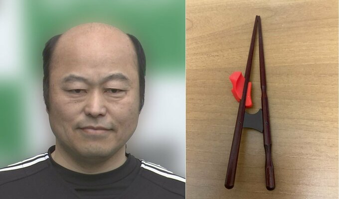 佐野慈紀さん　「矯正はしを使っています」　「不安を拭う為にも頑張る」　右腕切断手術後の状況明かす|TBS NEWS DIG